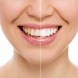 teeth whitening and bleaching nashua nh