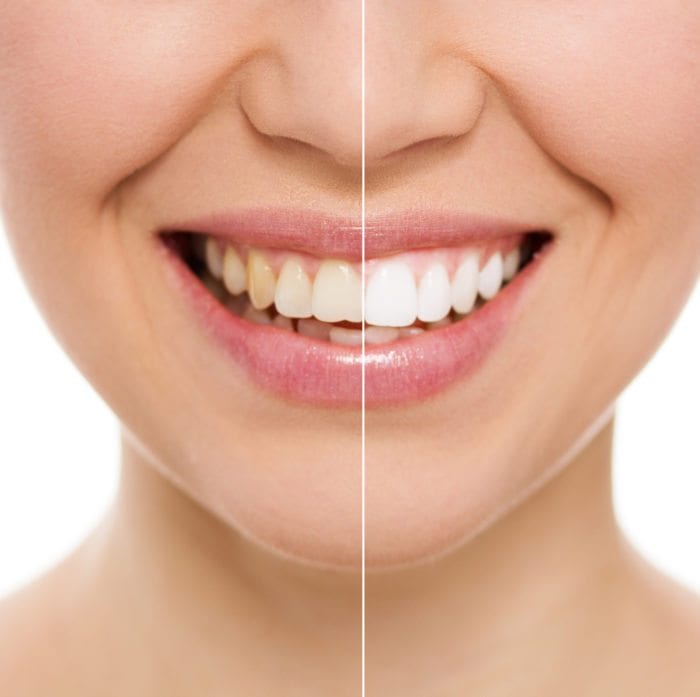 teeth whitening and bleaching in nashua nh