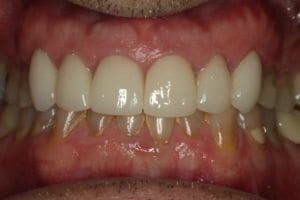 RF after tooth repair with crowns
