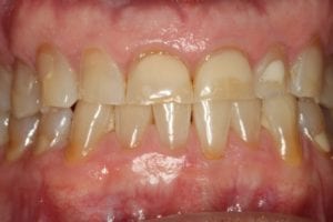 RF Before tooth repair with crowns