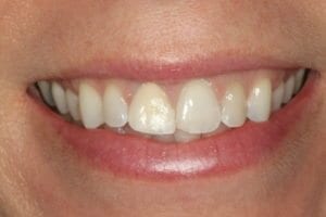 tooth contouring for an uneven bite