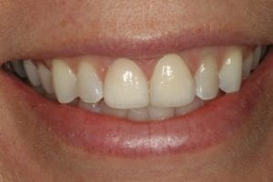 tooth contouring for an uneven bite