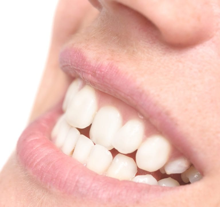 Straighten Crooked Teeth Without Braces Nashua NH Dentist Straighten Crooked Teeth Without Braces Nashua NH Dentist