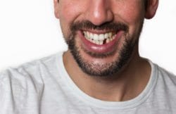 Missing Teeth replacement in Nashua NH