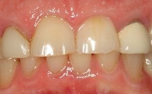 Nashua NH dental crowns for worn teeth