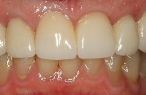 Nashua NH dental crowns for worn teeth