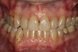 After Invisalign in Nashua NH