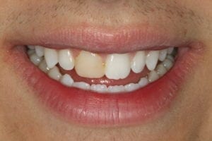 teeth whitening in Nashua NH