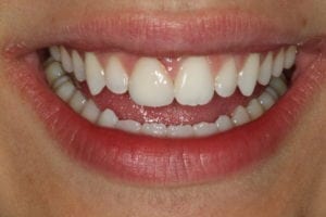 teeth whitening in Nashua NH