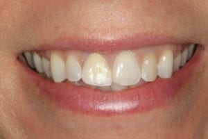 porcelain veneers for front teeth in Nashua NH