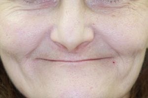 dermal fillers in Nashua NH at Levesque Dentistry