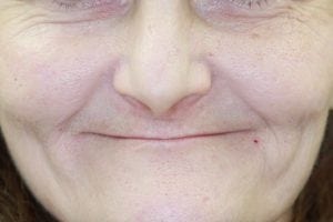 dermal fillers in Nashua NH at Levesque Dentistry
