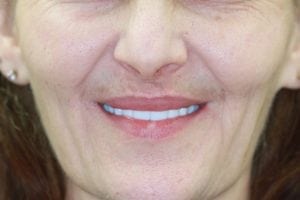 dermal fillers in Nashua NH at Levesque Dentistry