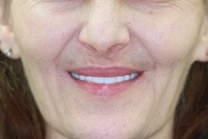 dermal fillers in Nashua NH at Levesque Dentistry