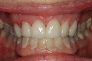 After prosthetic restoration