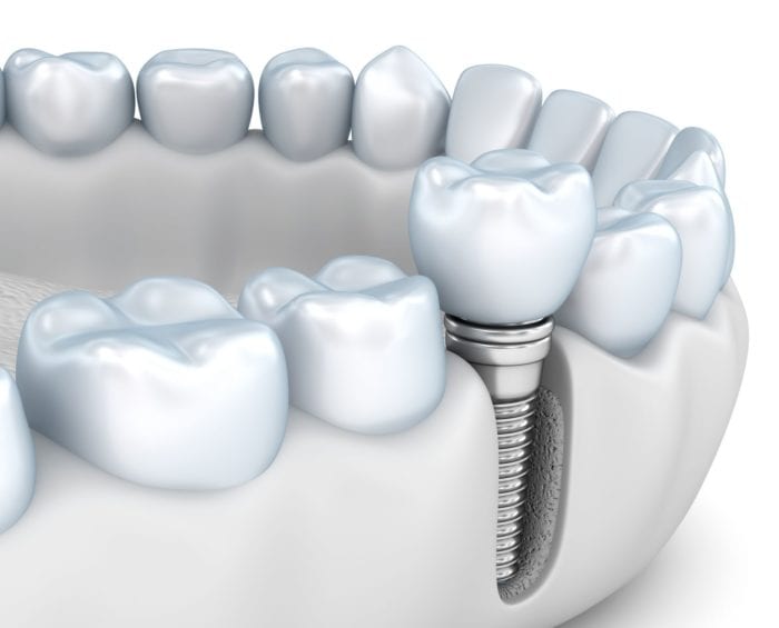 jawbone health with dental implants in Nashua New Hampshire