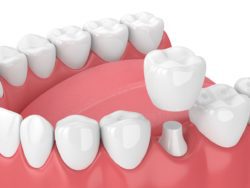 dental crown procedure Nashua New Hampshire