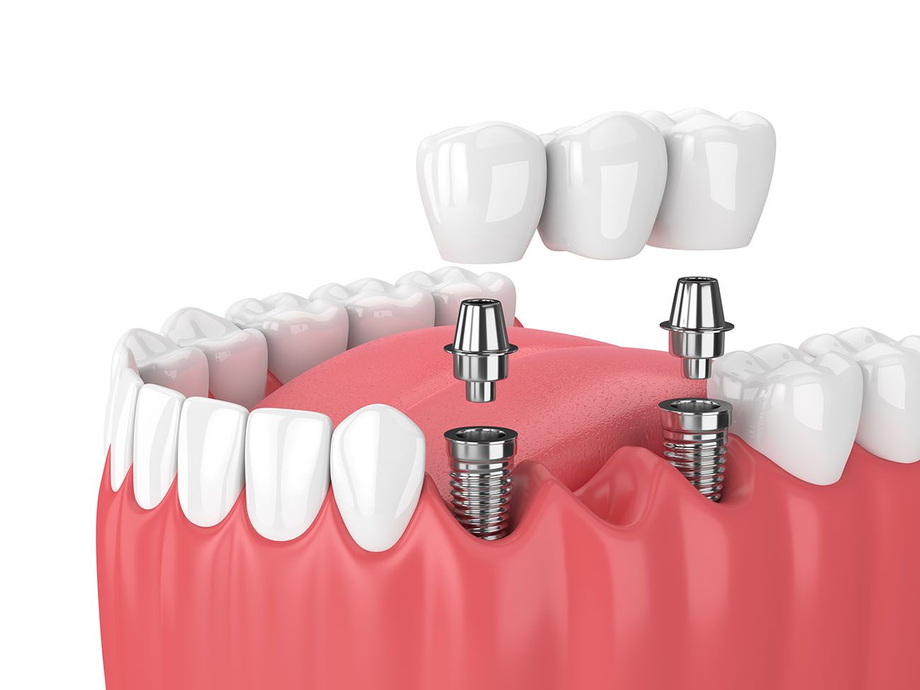 types of dental implants Nashua New Hampshire