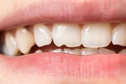 cosmetic dental damage from tooth enamel erosion
