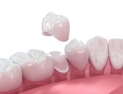 Same-Day Crowns? Yes, in One Visit in Nashua, NH